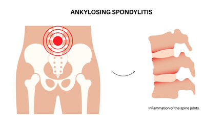 Ankylosing spondylitis disease