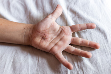 Red wound on the palm or arm after a burn or fall. First aid for treating wounds. Treatment of...