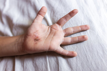 Red wound on the palm or arm after a burn or fall. First aid for treating wounds. Treatment of...