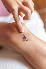 Close-up of a wound on the leg, a boy's bruise on the knee joint as a result of an accident or fall