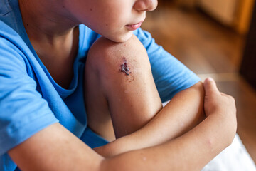 Close-up of a wound on the leg, a boy's bruise on the knee joint as a result of an accident or fall