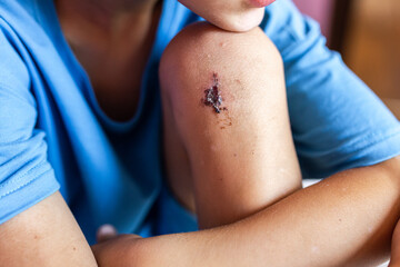 Close-up of a wound on the leg, a boy's bruise on the knee joint as a result of an accident or fall