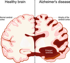 healthy brain and Alzheimer's disease. Neurodegenerative disorder. Dementia. - obrazy, fototapety, plakaty