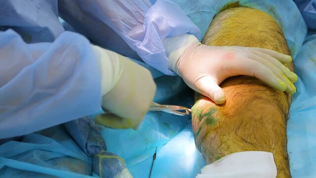 Medical surgery for endovenous laser photocoagulation of the great saphenous vein. Miniphlegectomy. Endovenous laser coagulation vein.