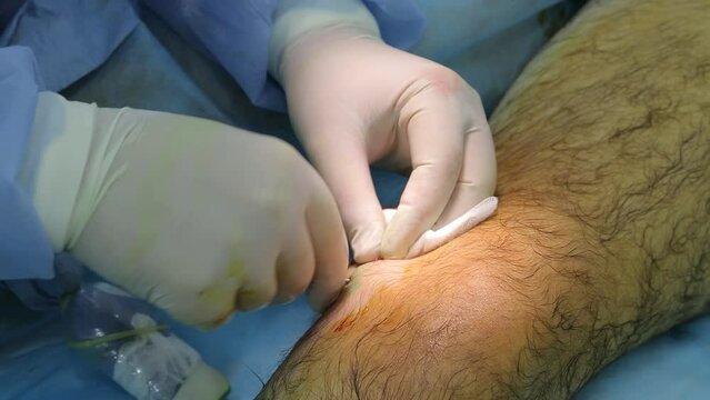 Medical surgery for endovenous laser photocoagulation of the great saphenous vein. Miniphlegectomy. Endovenous laser coagulation vein.