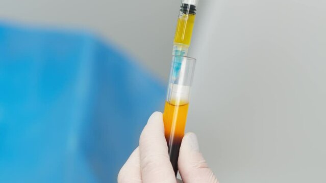 Doctor cosmetologist draws blood plasma into a syringe for the plasmolifting procedure, hands in gloves closeup. PRP therapy treatment in beauty clinic. Cure of problem skin.