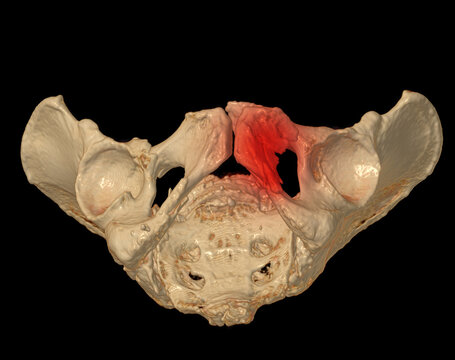 CT Scan of pelvic bone  3D rendering image showing superior pubic ramus fracture.