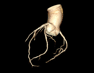  CTA Coronary artery  3D rendering image. CT angiographphy for heart disease .