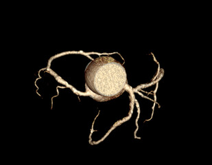  CTA Coronary artery  3D rendering image. CT angiographphy for heart disease .