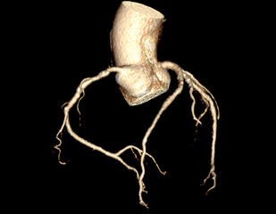  CTA Coronary artery  3D rendering image. CT angiographphy for heart disease .