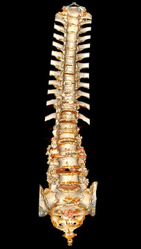  CT scan of thoracic and lumbar spine 3d rendering showing pedicle screw implant after surgical decompression and spinal fusion.