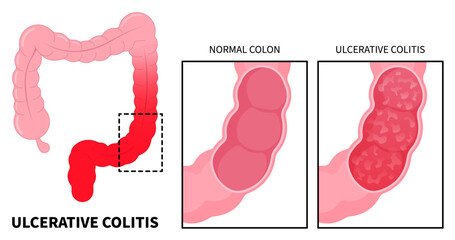 Anatomy of large intestines inflammation with ulcerative colitis and Crohn's disease that has ulcer painful or diarrhea - obrazy, fototapety, plakaty