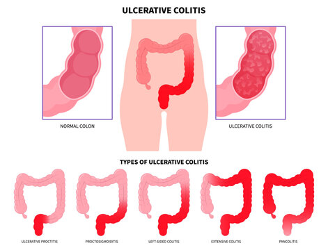 Constipation anatomy of large intestines inflammation with ulcerative colitis and Crohn's disease that has ulcer painful or diarrhea