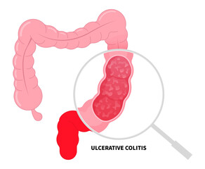 Chronic digestive colon inflammation of Ulcerative colitis and Crohn's disease with ulcer painful diarrhea