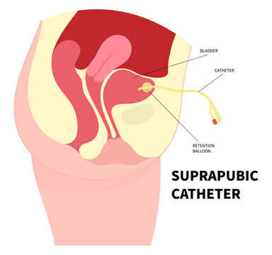 Bladder catheter to drain urine from urinary for the E coli bacteria infection by Catheterisation in urology urge leak urinating bag anatomy medical and pain gland or Enlarged cancer