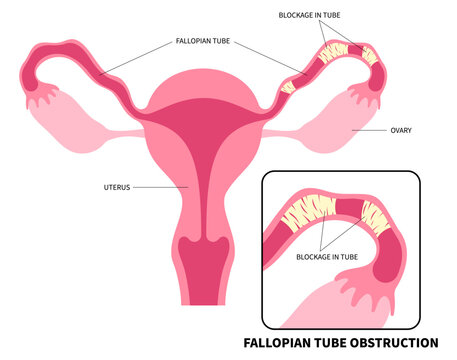 Uterine and female reproductive system with IVF or in vitro fertilization cause menstruation or ovaries painful