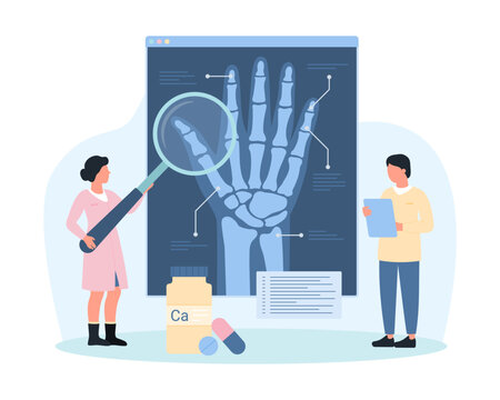 Diagnosis of osteoarthritis, rheumatoid arthritis using radiography vector illustration. Cartoon tiny people holding magnifying glass to examine xray of human wrist bones on medical exam in hospital