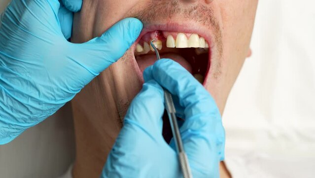 A tooth extraction and dental procedure.