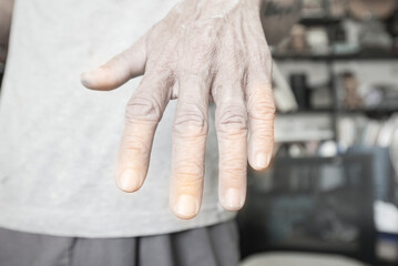 Peripheral neuropathy Finger muscles in older people