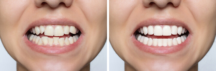 Young woman's smile before and after teeth straightening. Ideal, beautiful shape of teeth on the upper and lower jaw after installing veneers or braces. Bleaching. Dental clinic patient. - obrazy, fototapety, plakaty