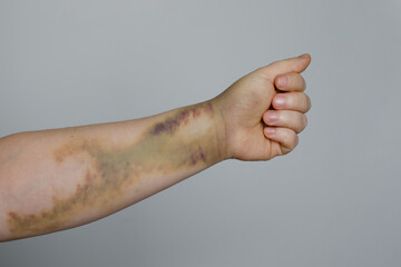 Car accident bruise on the woman's skin
