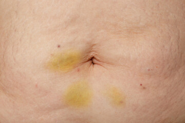 Wounds and bruises after medical injections on belly closeup