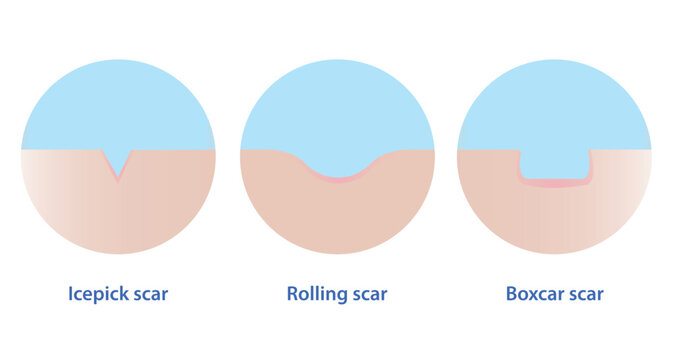 Acne scars vector icon set illustration isolated on white background.