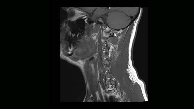 Computed medical tomography MRI scan of the cervical spine of a man with osteochondrosis