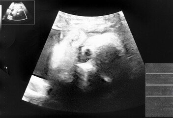 妊娠して30週目の胎児のエコー写真
