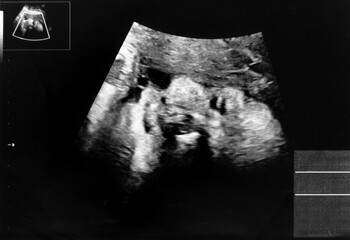妊娠して32週目の胎児のエコー写真