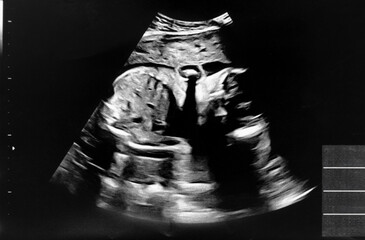 妊娠して24週目の胎児のエコー写真