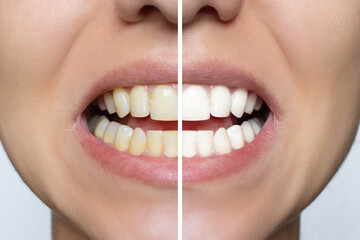 Women's teeth whitening close-up before and after the procedure. Upper and lower jaw. Dental clinic patient. Isolated on white background. Oral care. Dental treatment. - obrazy, fototapety, plakaty