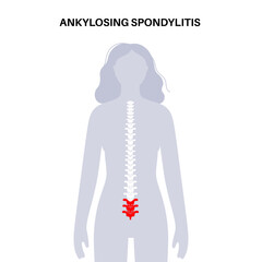 Ankylosing spondylitis disease