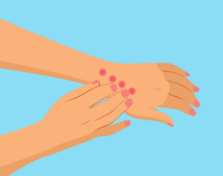 Patient with bed bug bite vector illustration on blue background. Arms with rash cartoon drawing