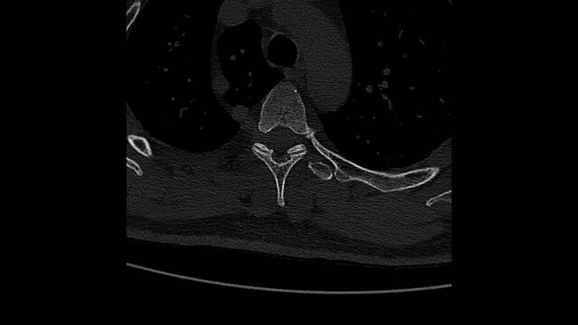Real Tomography Diagnostic of patient with osteoporosis, pain in the spine. Magnetic Resonance Imaging MRI scanner Radiology. Computed x-Ray Medical Imaging