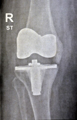 Plain X-ray showing Total right knee replacement arthroplasty after joint osteoarthritis grade 4, a...