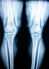 Plain X ray of both knee joints shows apparent joint osteoarthritis according to Kellgren and Lawrence system for classification of osteoarthritis with definite osteophytes and joint space narrowing