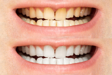Fototapeta premium Teeth before and after whitening. Taking care of oral hygiene. The concept of beautiful teeth. Close-up.