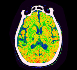 CT Brain Perfusion or CT scan image of the brain axial view  showing  cerebral blood flow on the monitor at stroke area.
