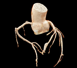  CTA Coronary artery  3D rendering image showing coronary tree and heart 3D.