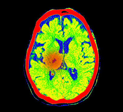 CT Brain Perfusion or CT scan image of the brain axial view  showing  cerebral blood flow on the monitor at stroke area.