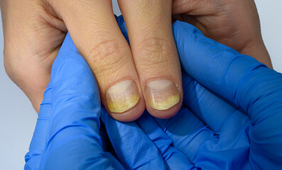 Choroba łuszczyca paznokci z bliska