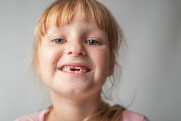 The child shows baby teeth. Pediatric dentistry and periodontology, bite correction. Health and dental care, caries treatment, baby teeth