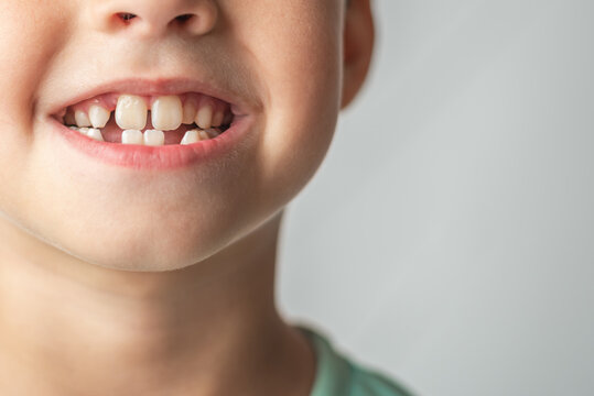 The child shows baby teeth. Pediatric dentistry and periodontology, bite correction. Close-up