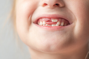 The child shows baby teeth. Pediatric dentistry and periodontology, bite correction. Close-up