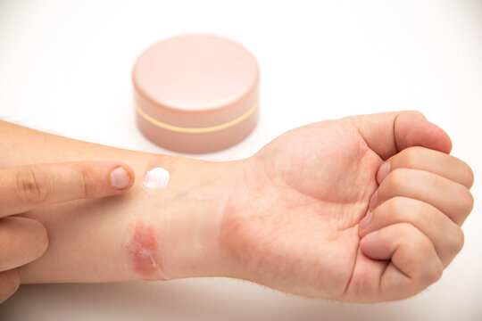 A man applies medicinal cream to redness on his wrist due to diaper rash and irritation of the silicone watch strap. Allergic contact dermatitis, close-up