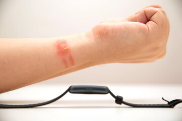 Redness and allergies on a person s wrist from wearing a fitness bracelet with a silicone strap....