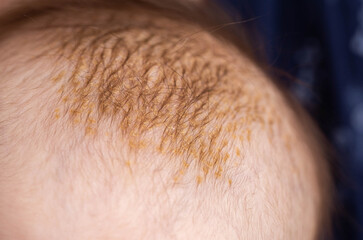 Milk crusts on the head of a newborn child, gneiss. The formation of yellow-golden scales on the...