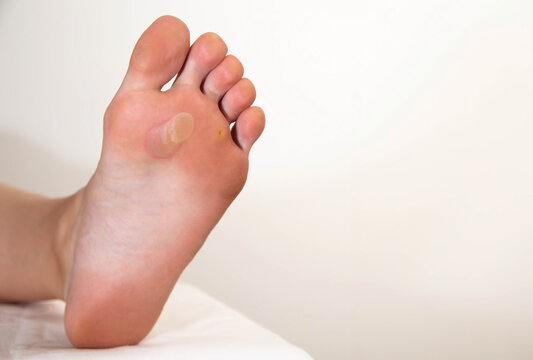 A person's foot has a large callus on its foot due to rubbing from uncomfortable shoes. Rod wart on the sole of the foot, close-up. Copy space for text