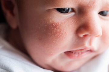 Allergic pimples in a newborn on the face. Pathogenesis, acne of newborns.